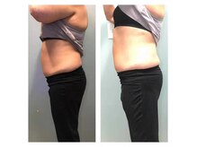 クライオ360(Cryo360)/脂肪冷却ビフォーアフター