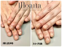 モアナ 池袋(MOANA)/人工爪深爪