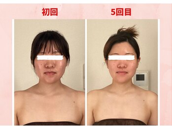 リラココ(リラcoco)/ビフォーアフター(20代お客様)