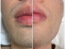 ヴァイオス 新宿店(VIOS)/◆ヒゲ脱毛【before/after】