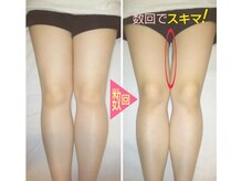 スタイル整体 やまもと整骨院/数回で内モモにスキマ作りました
