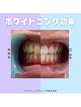 ホワイトニングショップ 大阪玉造店/ホワイトニングbeforeafter！