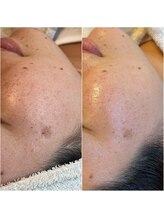 ビマリア(美-MARIA)/シミケア