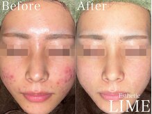 ライム 千葉(LIME)/ハーブピーリング|ニキビケア