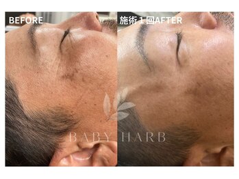 フィズ 溝の口店(FIS)/☆ハーブピーリング☆都度払い