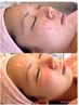 【繰り返すニキビ・毛穴】ハーブピーリング×毛穴洗浄×高濃度美容液パック