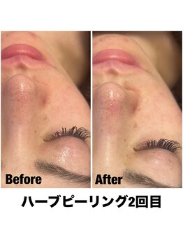 Sスタイルスタジオ 福岡天神/ハーブピーリング2回目のお客様