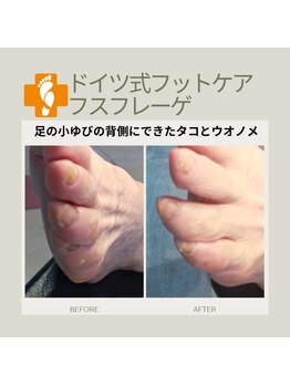 フスフレーゲ 学芸大学店/小ゆび背面のタコ・ウオノメ