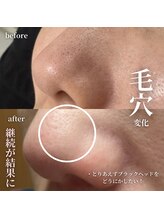 ララ(LaLa.)/毛穴洗浄