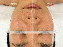 センガン(SENGAN)/美点でやさしく流して引き上げる