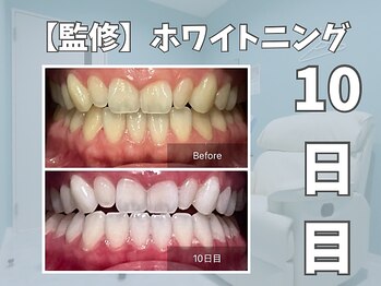 エックス(X)/【監修】ホワイトニング