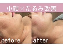 キワミ サーティスリー(kiwami33)/光フェイシャルEMSの組み合わせ