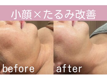 キワミ サーティスリー(kiwami33)/光フェイシャルEMSの組み合わせ