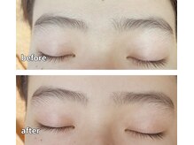 柏ベルミーランド/脱毛before→after