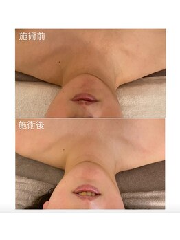 ピーロ ルレ(salon Piilo Rule)/before/after