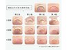 【巻爪矯正】巻き爪でお悩みの方に☆(1本施術)