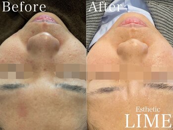 ライム 千葉(LIME)/ハーブピーリング|ニキビケア