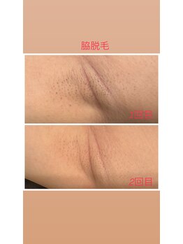 サンデートータルビューティーサロンニイガタ(Sunday Total Beauty Salon niigata)/脇脱毛