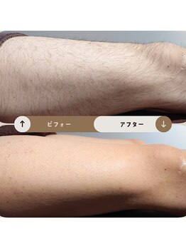 ジュゴン(Dugong)/足の全体脱毛（Before＆After）