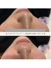 ディアー(Dear)/プラズマパールリフト