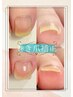 【初回限定】 巻き爪補正＋カウンセリング ￥16,500→￥11,000