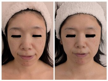 レゾン 京橋店/最新！韓国美容☆レモンボトル