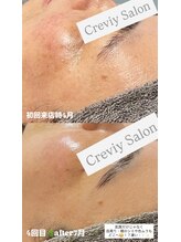 クレヴィー(Creviy)/陶肌トリートメント4回の変化