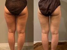 プシュケ(PSYCHE)/30代女性ビフォーアフター