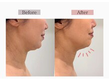 即日あご下スッキリ◎【フェイスライン再形成/麻布十番/小顔】