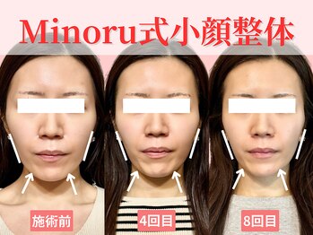 フレキシボディ(FlexiBody)/小顔施術ビフォーアフター #20