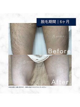 メンズクリア 倉敷店/【メンズクリア】お客様の施術例