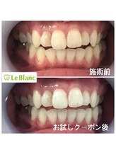 ルブラン 奈良店(Le Blanc)/お試しで効果実感！！