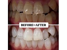 ホワイトニングサロン 豊中/Before&After美白ホワイトニング