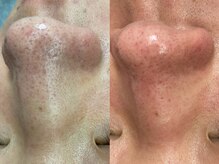 ヴィーヴ 京橋(vive)/【韓国式3D毛穴洗浄】