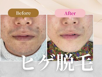 フェルナ 南森町店(FERNA)/脱毛