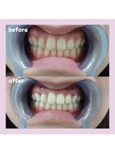 パレ 大阪十三店(Palet)/３回照射後のbefore/after