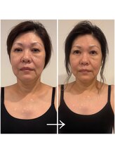 ドクターボディ 浜松店(Dr.Body)/【たるみ/ほうれい線/目の重み】