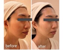 レディーススパアンドエステ テフ ホテル阪神(TeF)/20～30代 小顔むくみ