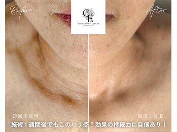 チエミ(Chi e mi)/首元のシワも改善★若々しい印象