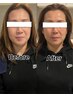 【リフトアップ、中顔面短縮、むくみ、肩こり】小顔矯正