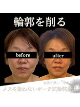 クリニカルボーテ 心斎橋院(CLINICAL BEAUTE)/不要な脂肪を燃焼すっきり小顔に
