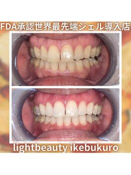 ライトビューティー 池袋店(LightBeauty)/症例写真