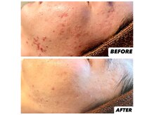 ジャスミン(JASMINE)/ハーブピーリング半年後の結果