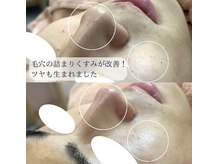 ミュー 自由が丘店(mieux)/◆肌質改善例