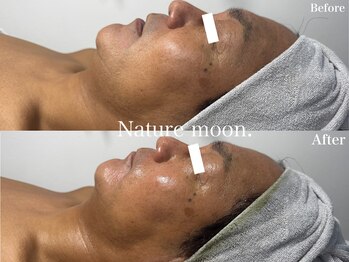 ナチュールムーン(Nature moon.)/ハーブピーリング
