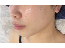 トゥモロー(TOMORROW)/ハーブピーリング/肌質改善