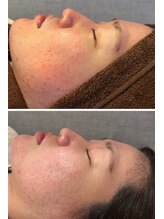 エムアイ 六本木(Mi)/水光ピーリング