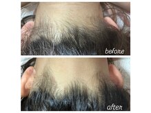 エナッシュビューティサロン(ENASH)/うなじ脱毛