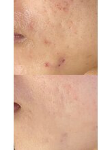 ラペカ(Lapeca)/ハーブピーリング専門店名古屋