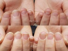 ミンスネイル(Mins Nail)/深爪矯正before&after 